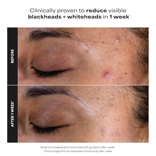 Paula’s Choice 2% BHA Liquid Exfoliant – Smooths Pores & Fine Lines features